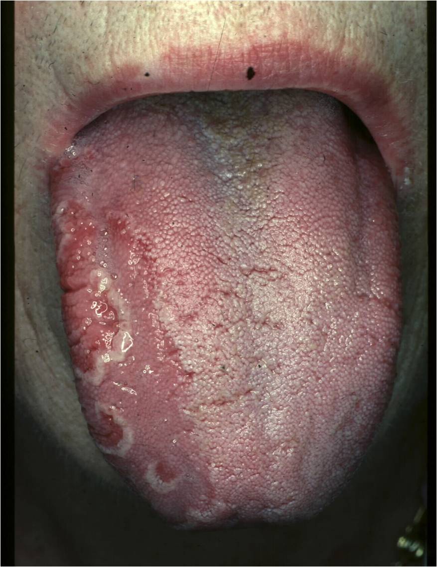 Psoriasis Of The Tongue