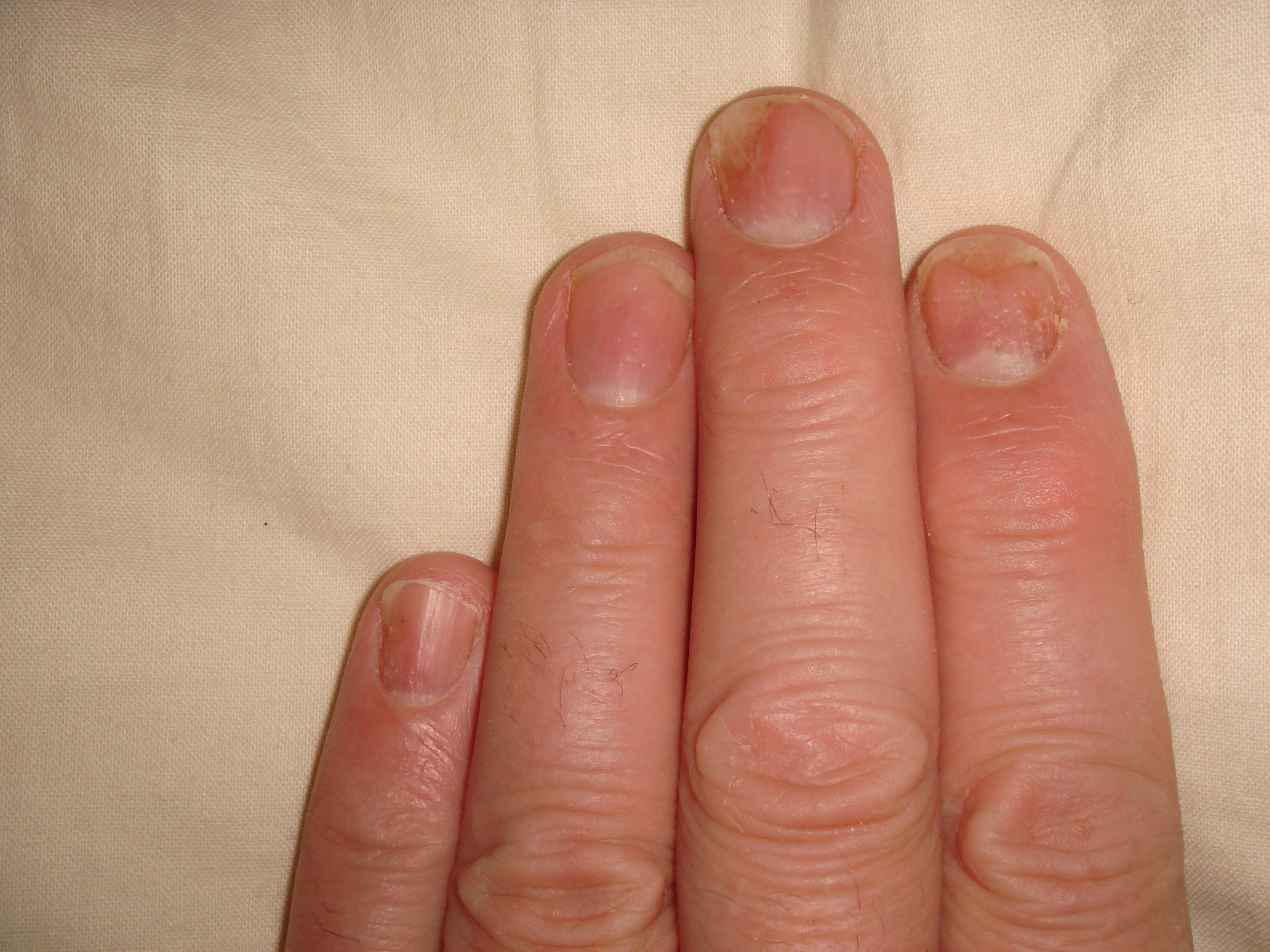 Nail Psoriasis (2)