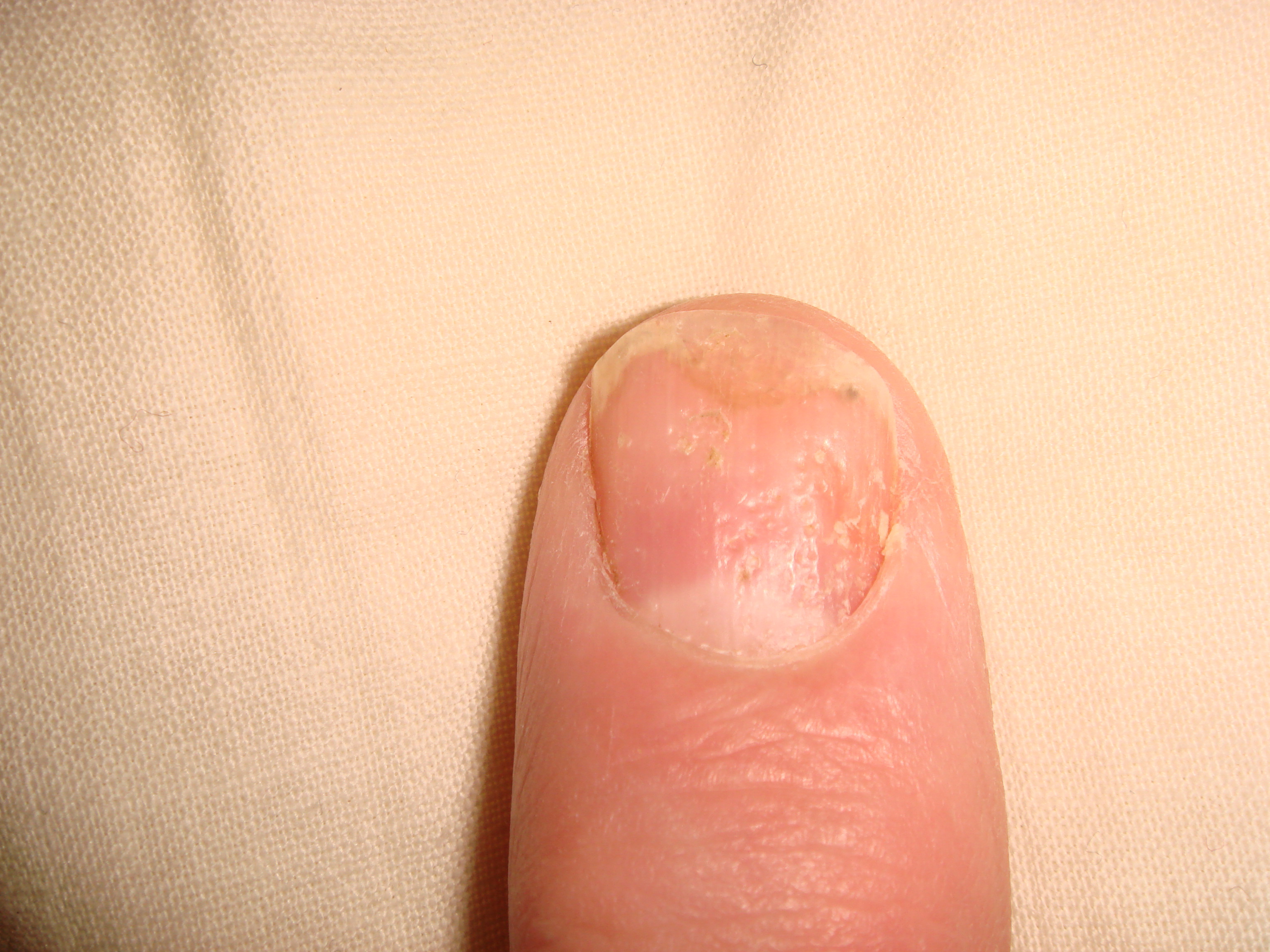 Nail Psoriasis (3)