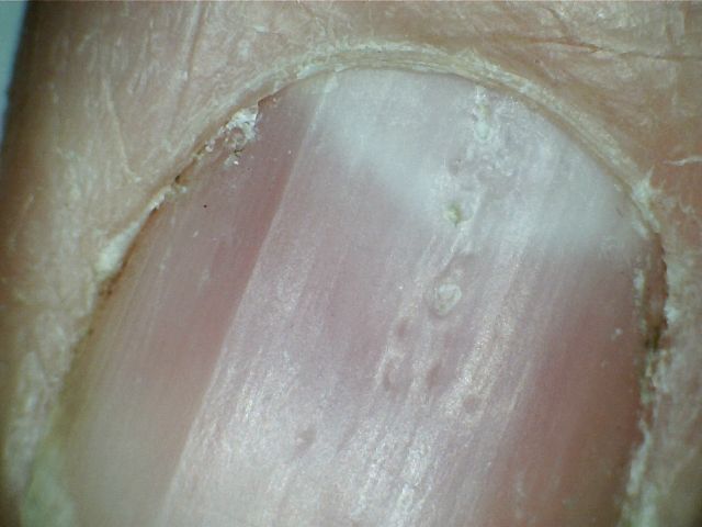 Nail Psoriasis Pitting