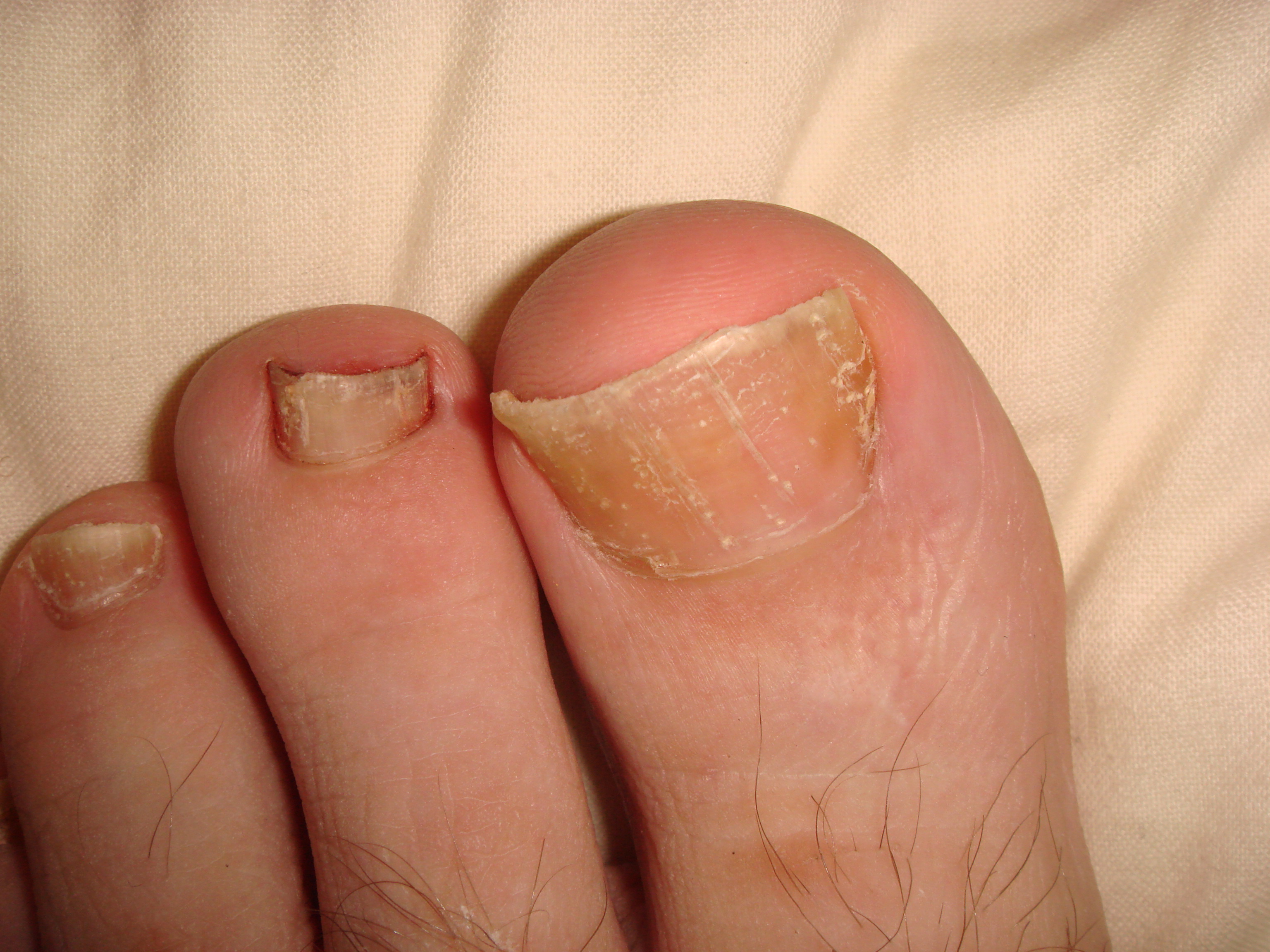 psoriasis on toenails