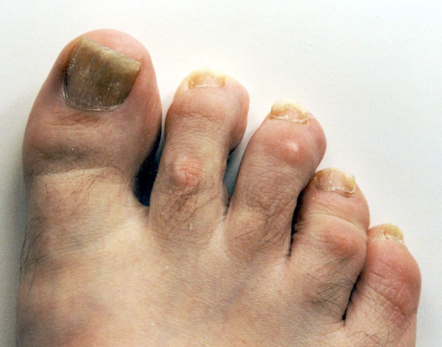 Psoriasis Toes