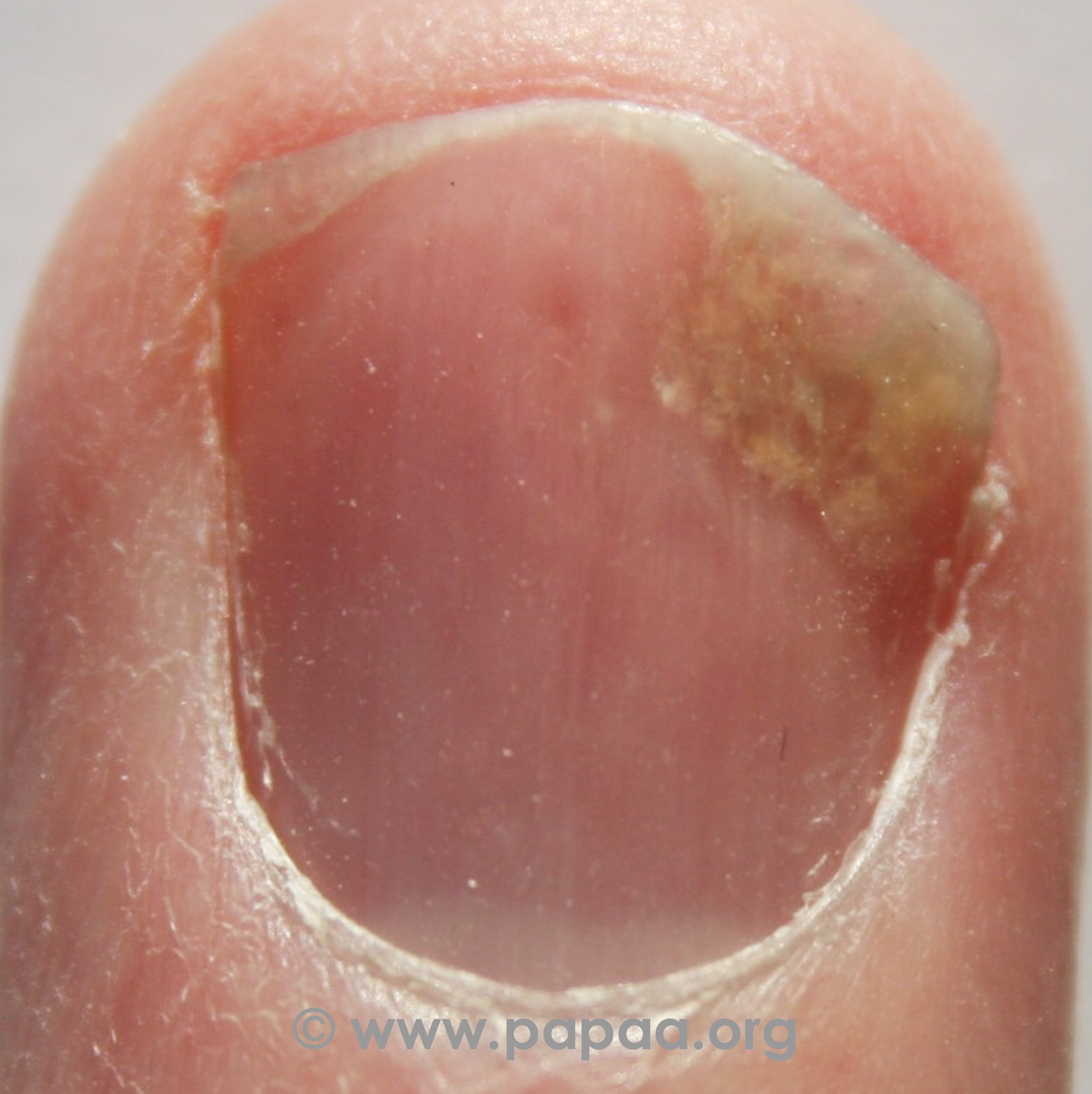 nail psoriasis after pregnancy)