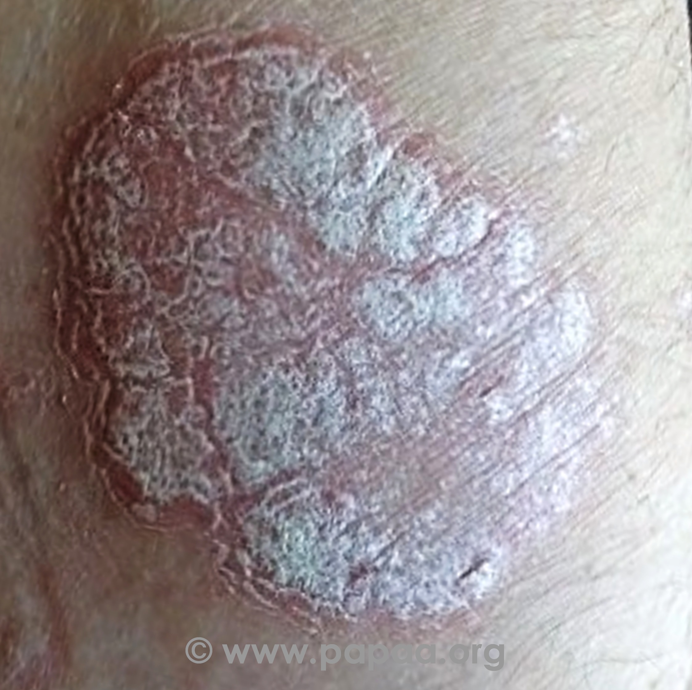 Plaque psoriasis (raised silvery scales)