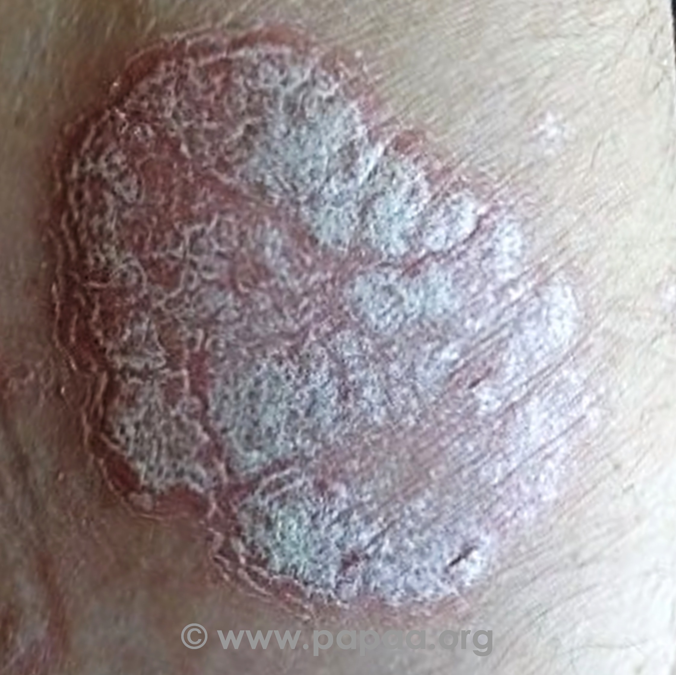 weeping psoriasis treatment