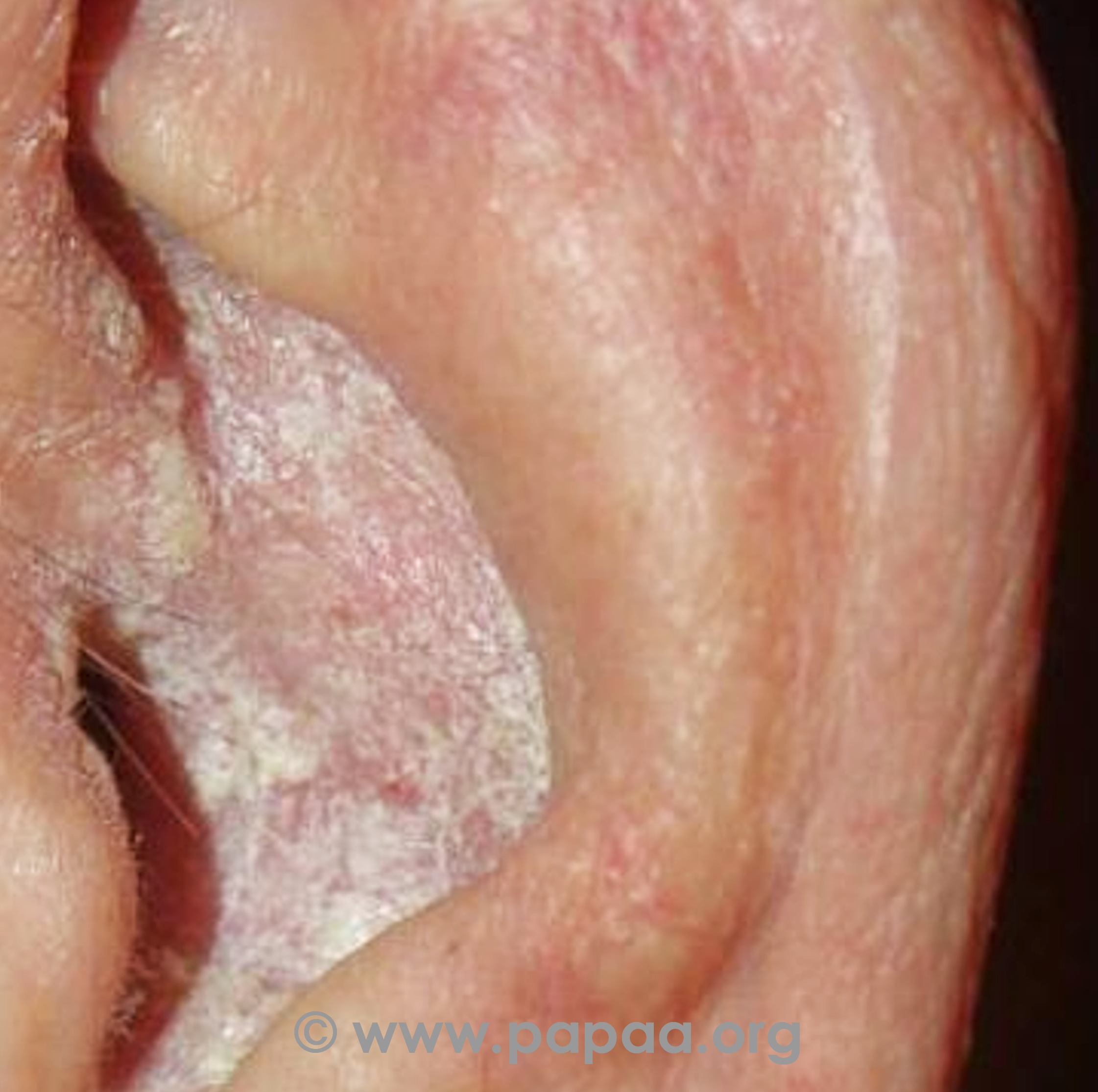 Psoriasis in ear (scaly blocking canal)