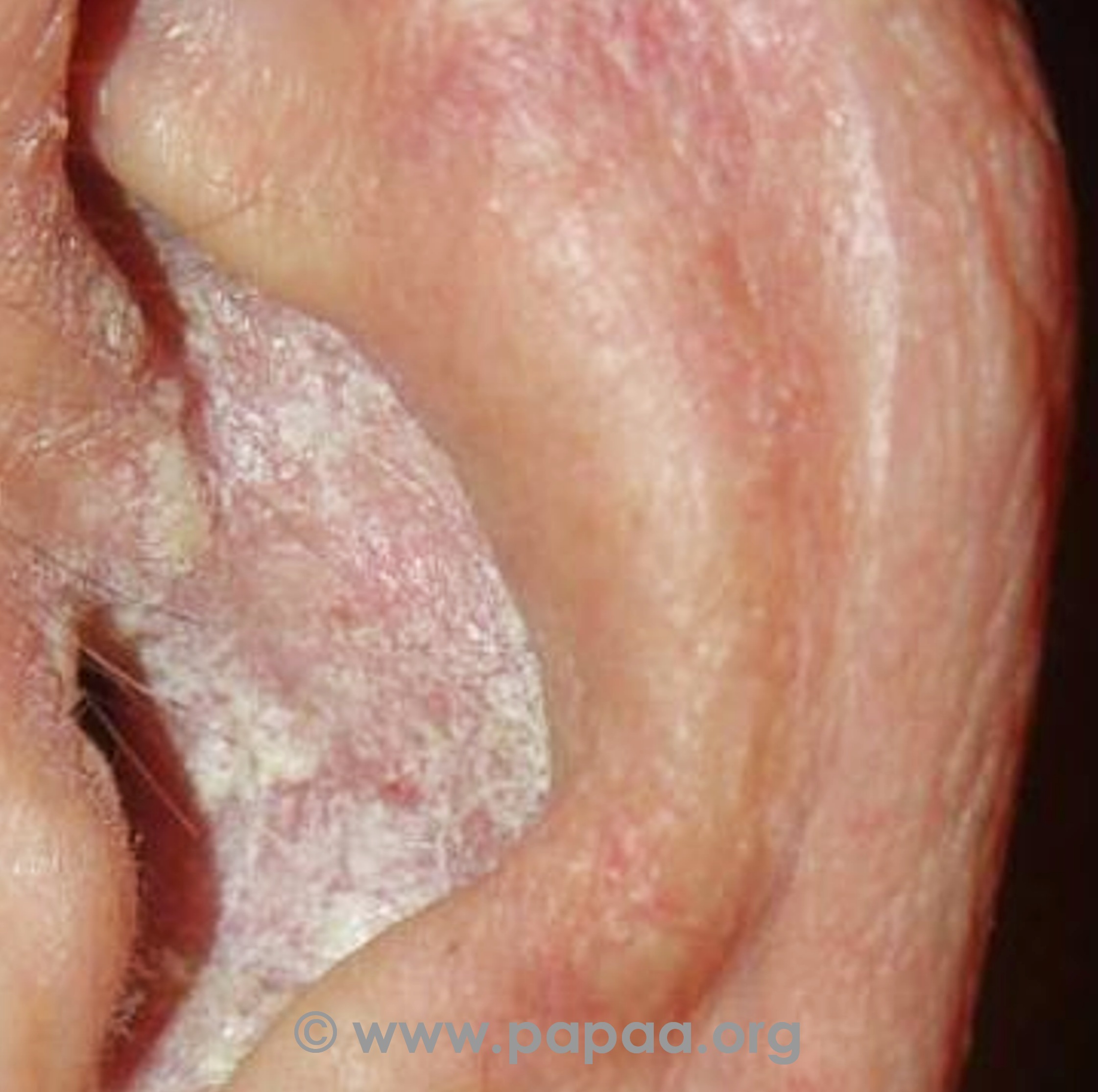 Plaque Psoriasis Ears