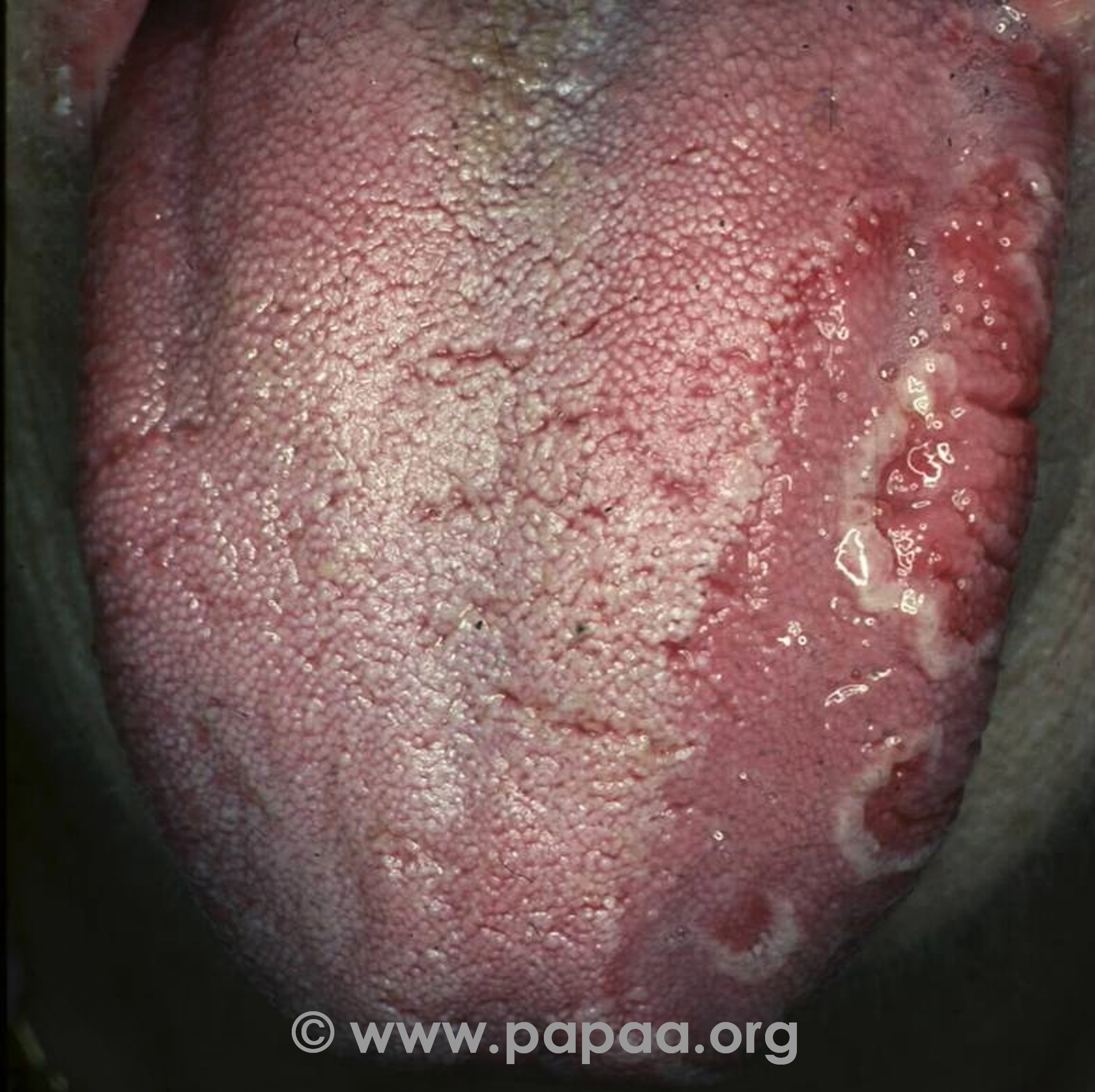 Geographic tongue (psoriasis)