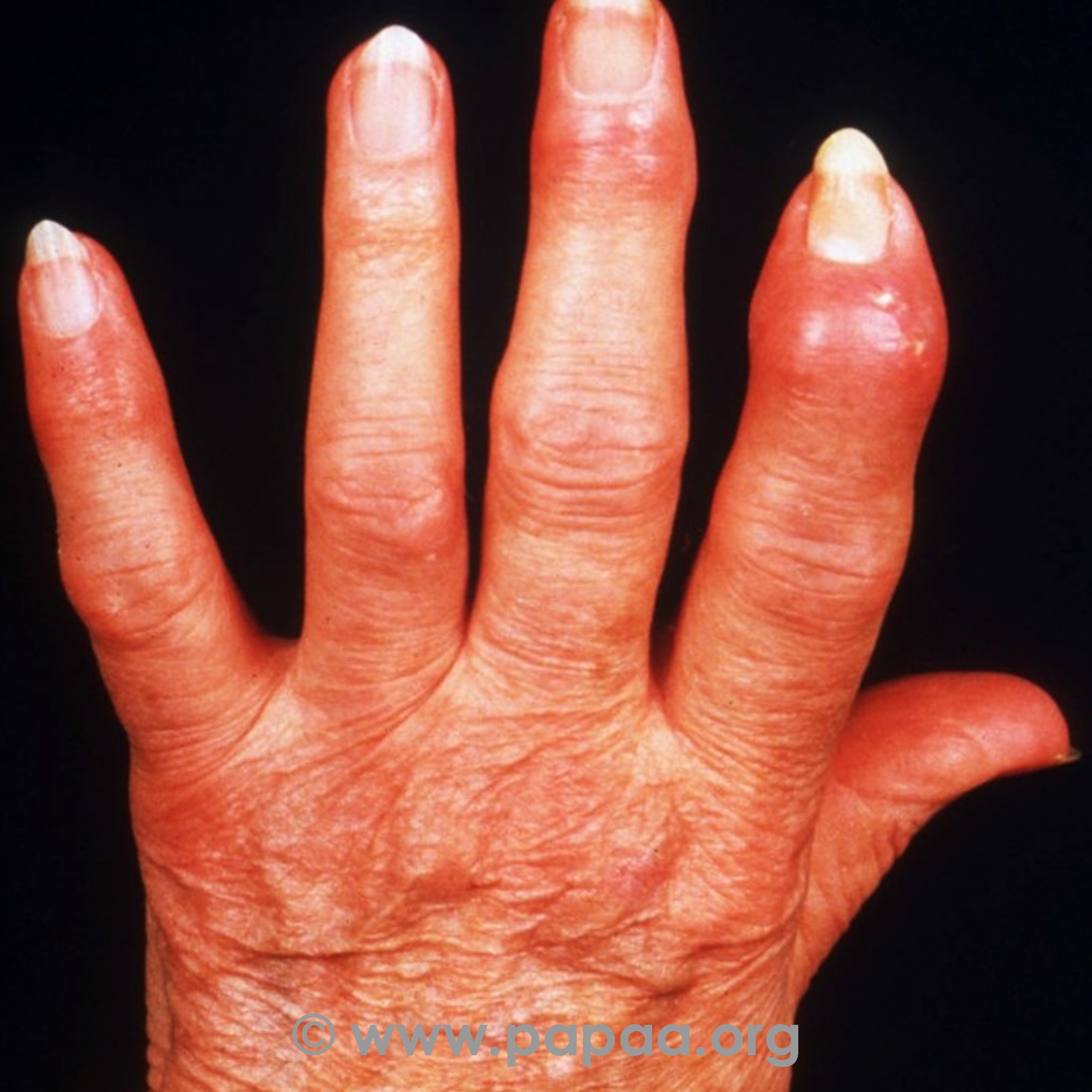 Psoriatic arthritis (PsA) 'sausage digits'