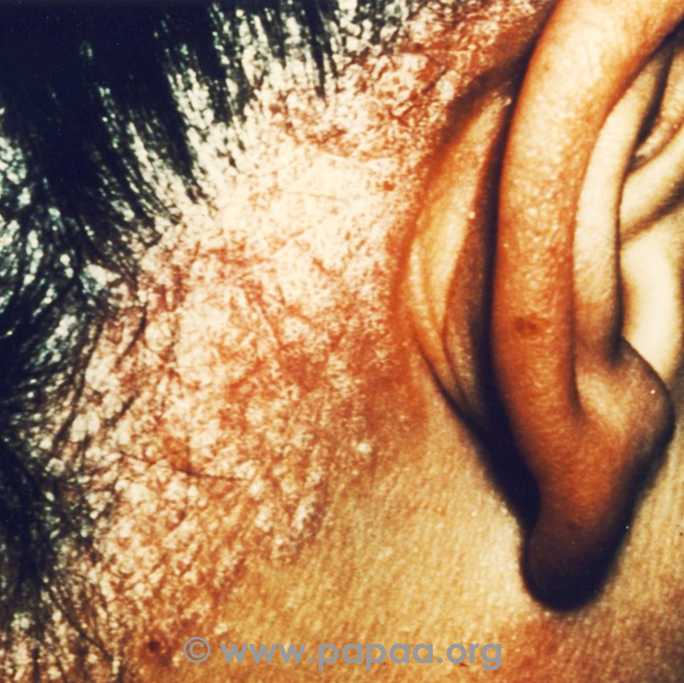 Scalp psoriasis (hairline and ear)