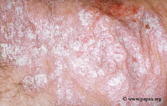 Plaque psoriasis.jpg