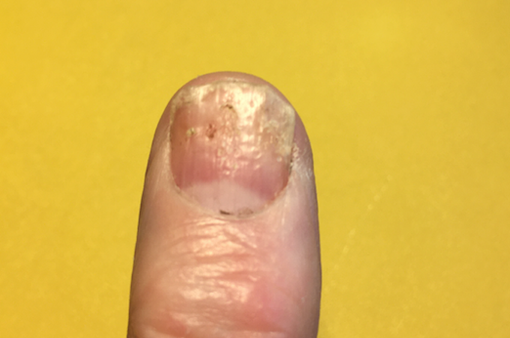 nail ridging psoriasis