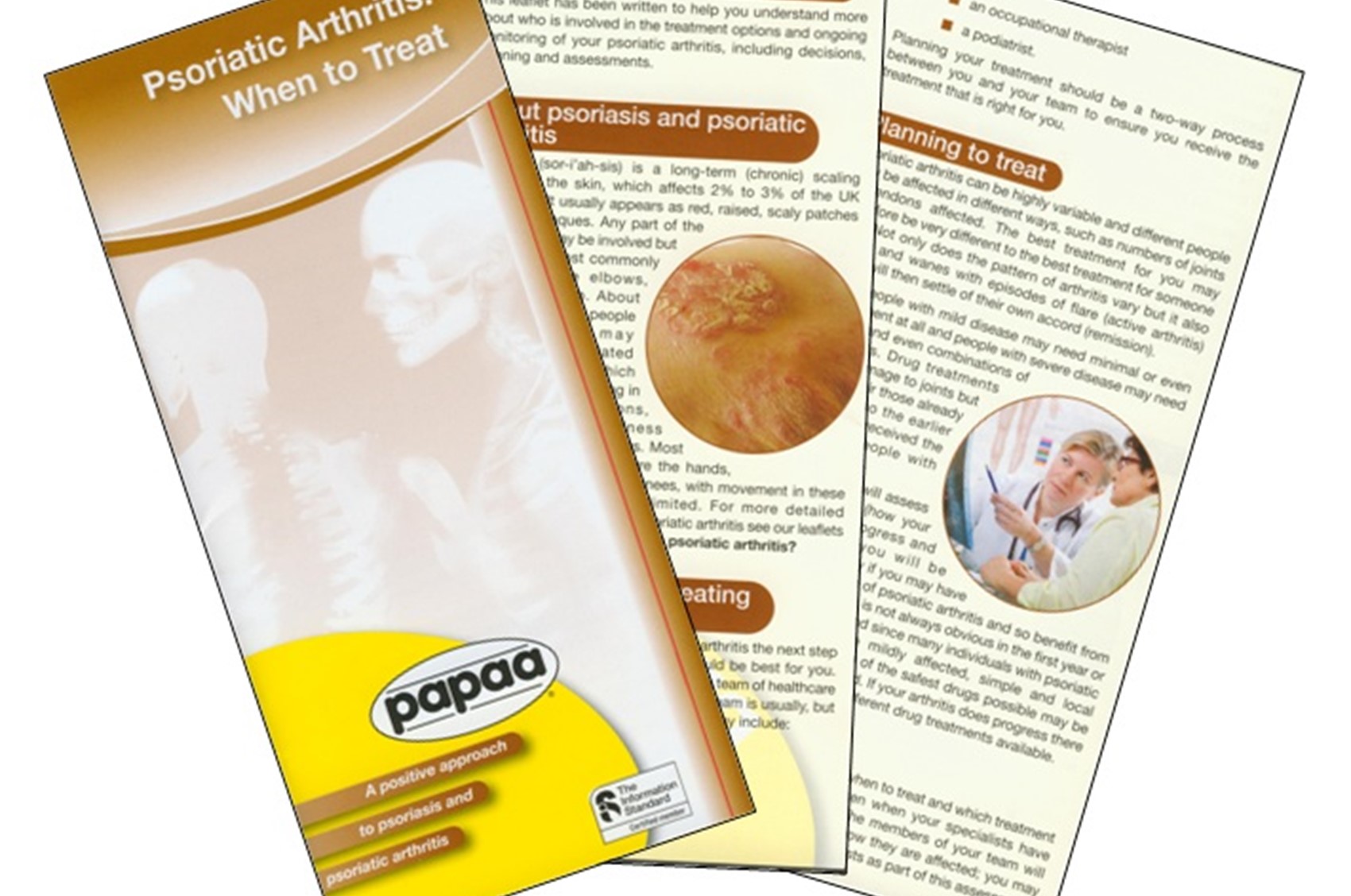 Psoriatic Arthritis When to treat