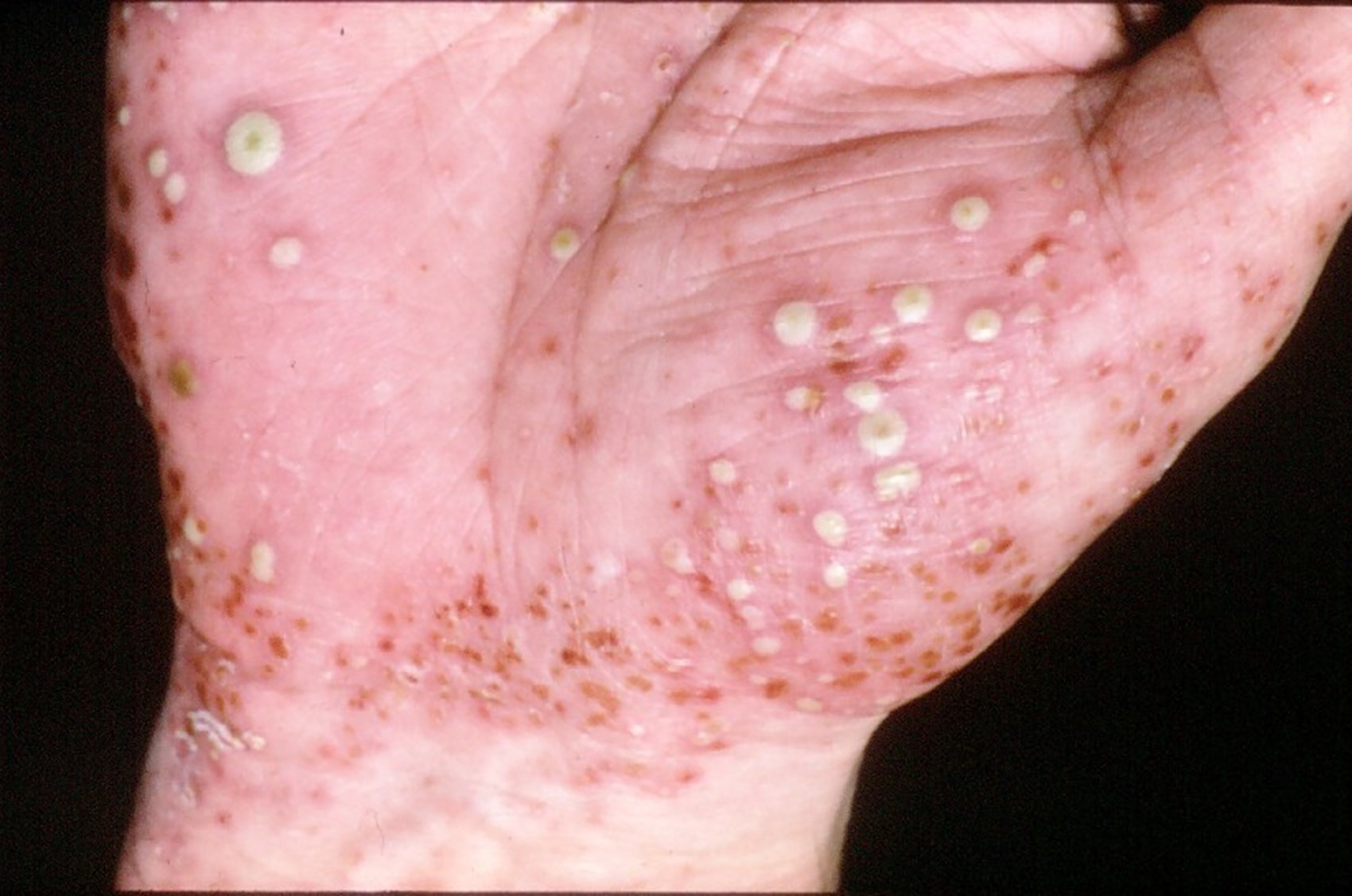 What does pustular psoriasis look like and how is it different?
