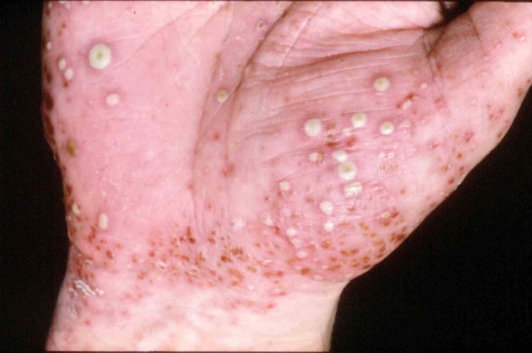 Pustular psoriasis.jpg