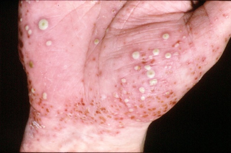 What does pustular psoriasis look like and how is it different?
