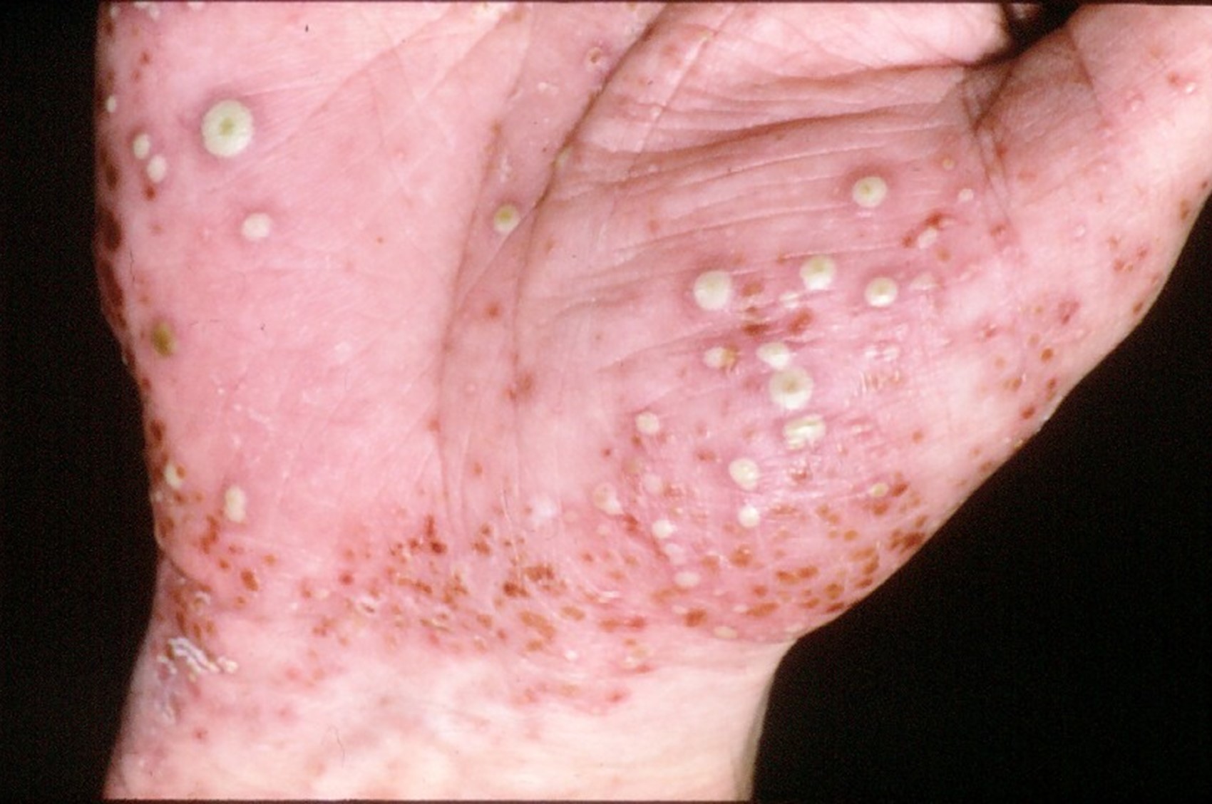 psoriasis pustular feet)