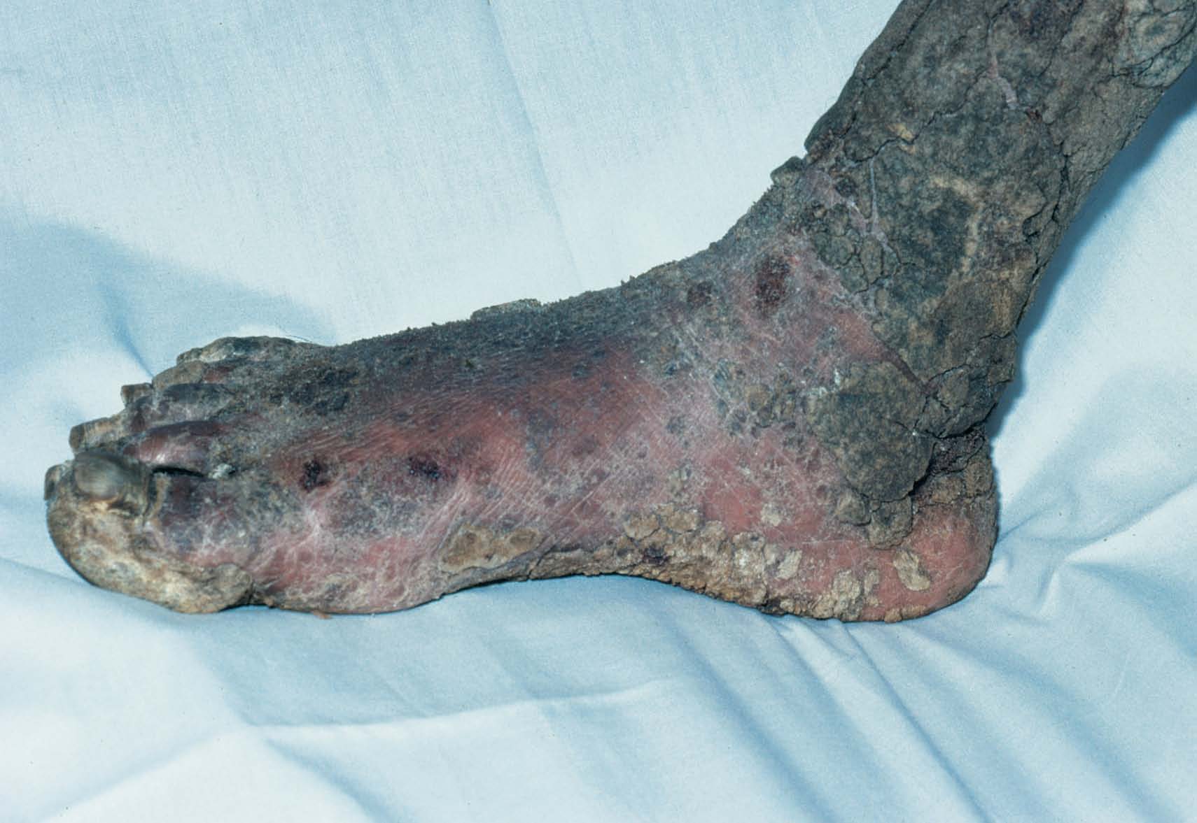 Hyperkeratotic psoriasis on foot.jpg