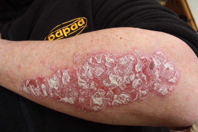 Who Gets Psoriasis, Large Plaque On Elbow