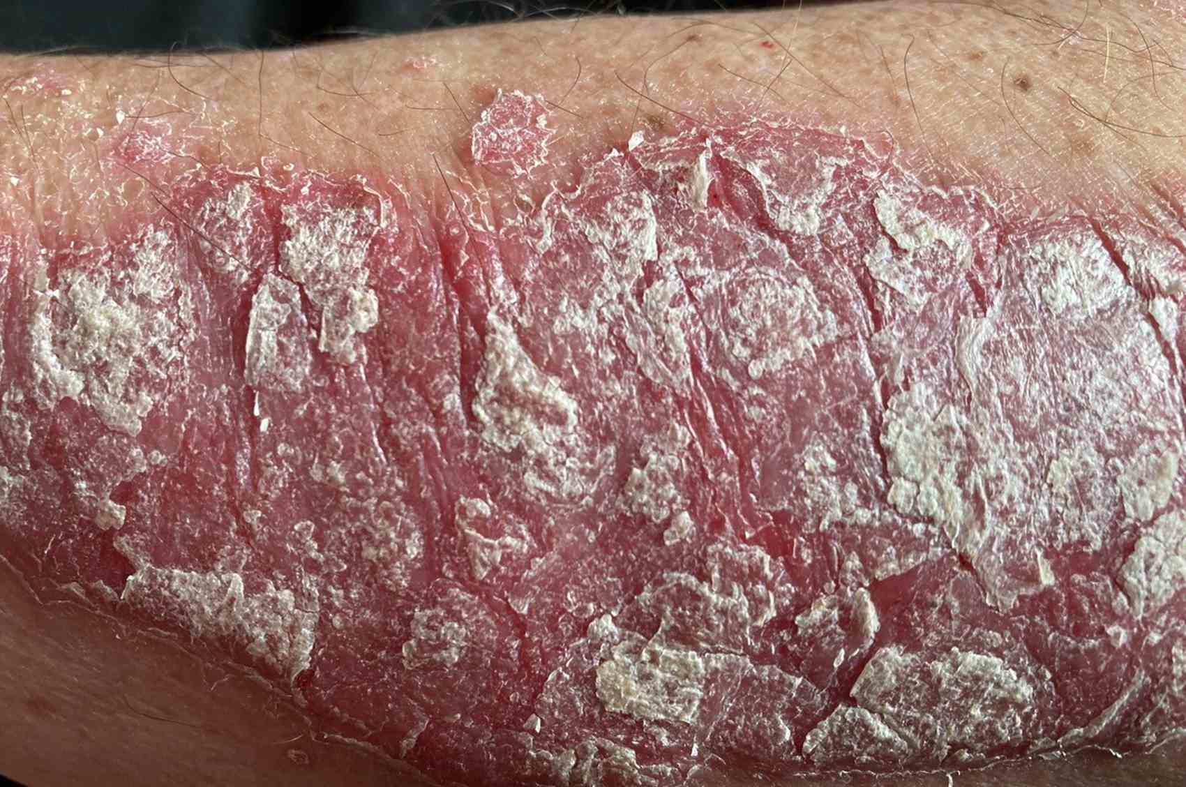 Plaque Psoriasis Cardiovascular Risk