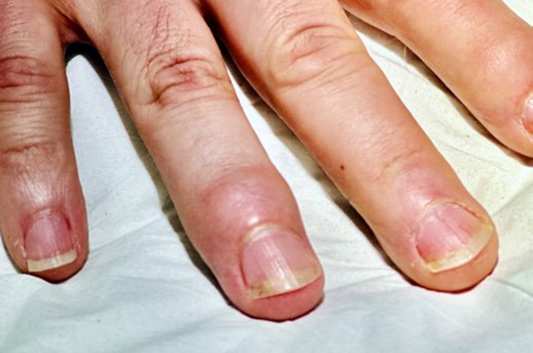 What Is Psoriatic Arthritis0005 01