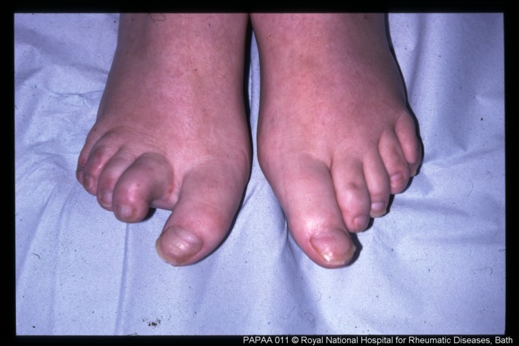 Psoriatic arthritis feet.jpg