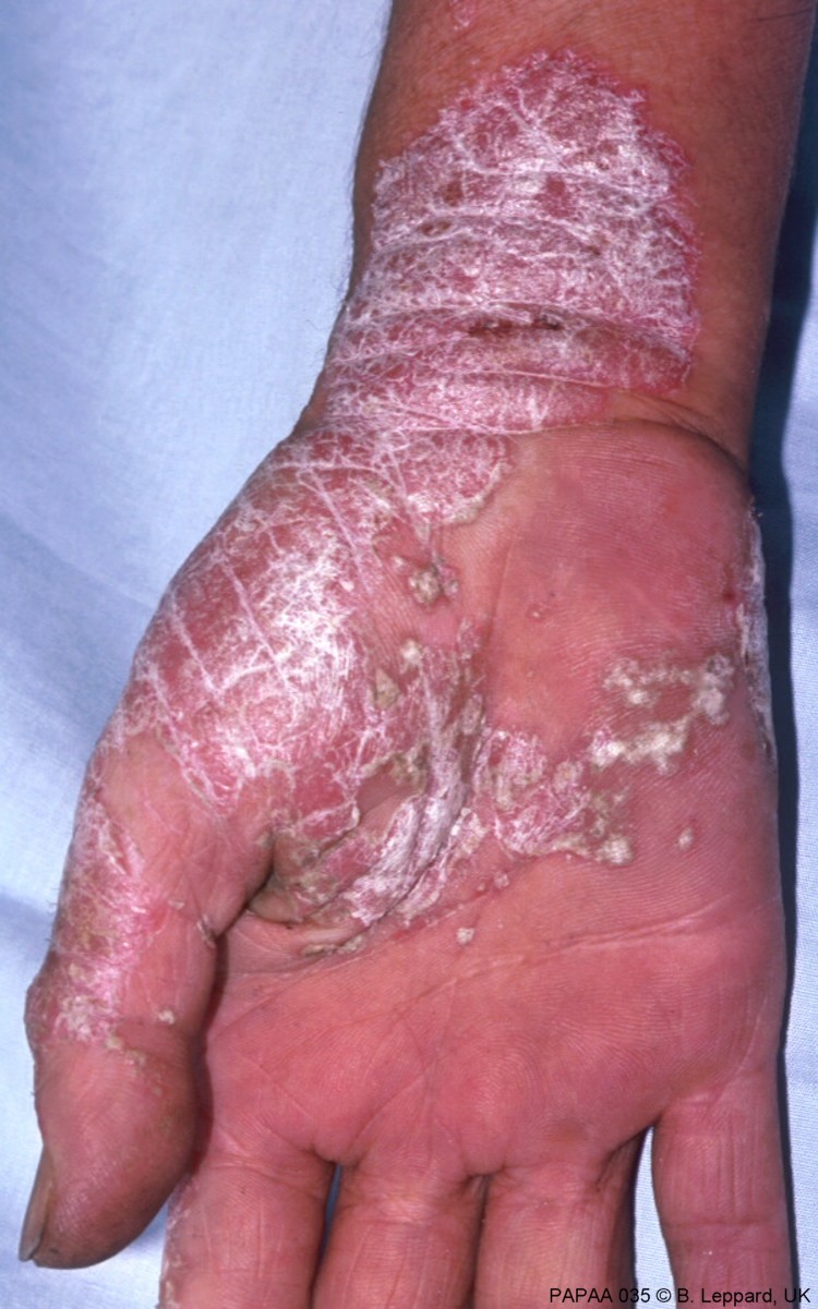 Plaque psoriasis on hand and wrist.jpg