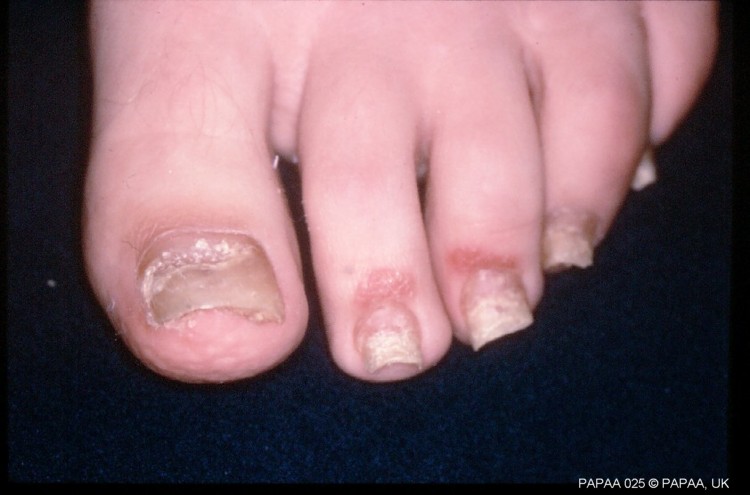 Nail psoriasis 9.jpg