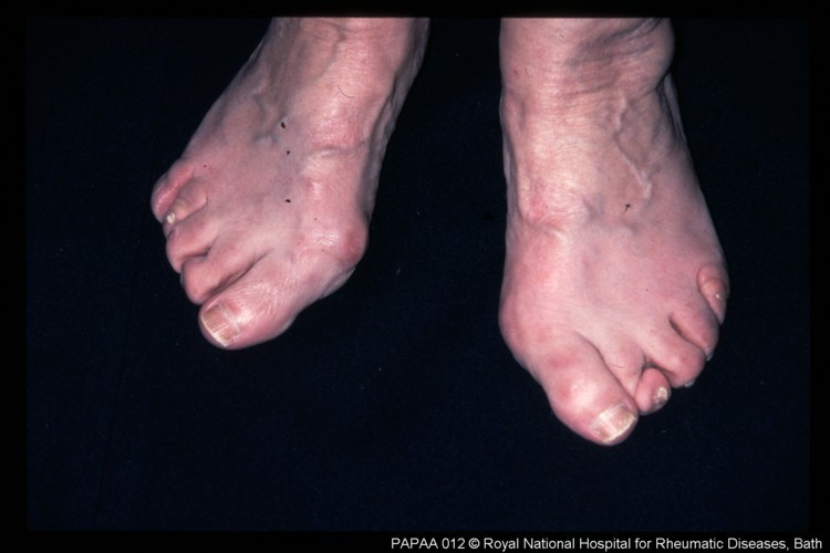 Psoriatic arthritis feet 2.jpg