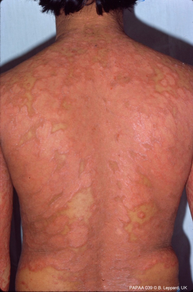 Widespread plque psoriasis on back.jpg