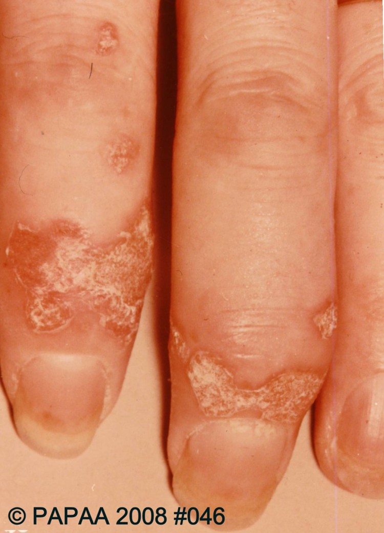 Psoriasis and psoriatic arthritis in finger joints (DIP).jpg