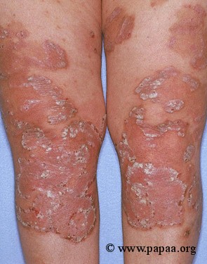 Plaque psoriasis on knees.jpg