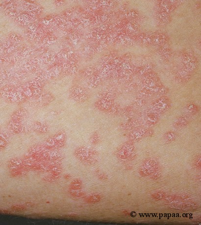 Widespread plaque psoriasis.jpg