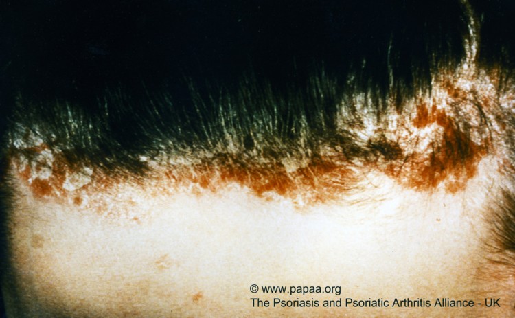 Scalp psoriasis 1.jpg