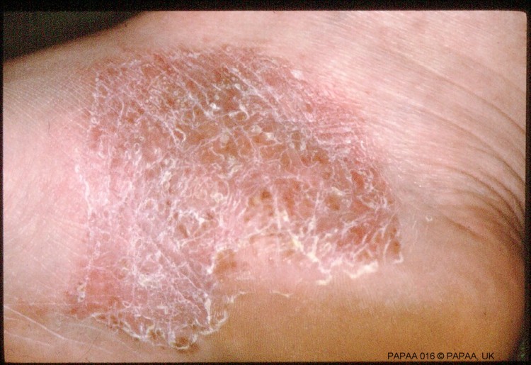 Plaque psoriasis on foot.jpg