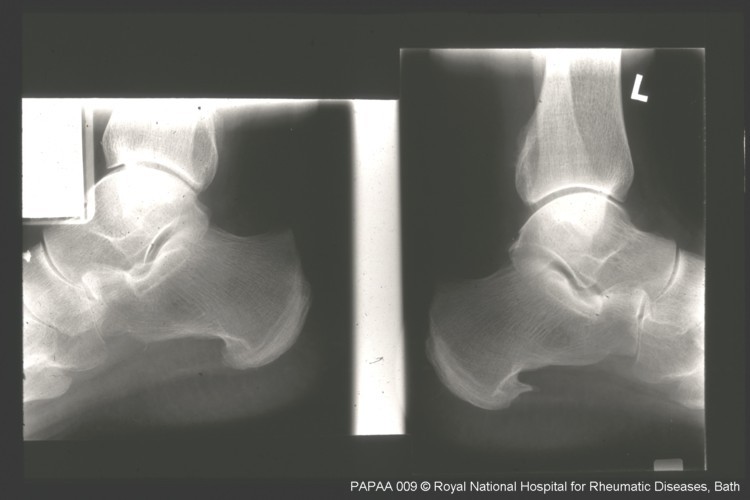 Psoriatic arthritis xray.jpg