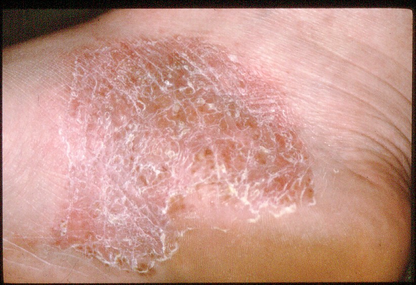 Psoriasis and psoriatic arthritis on the feet