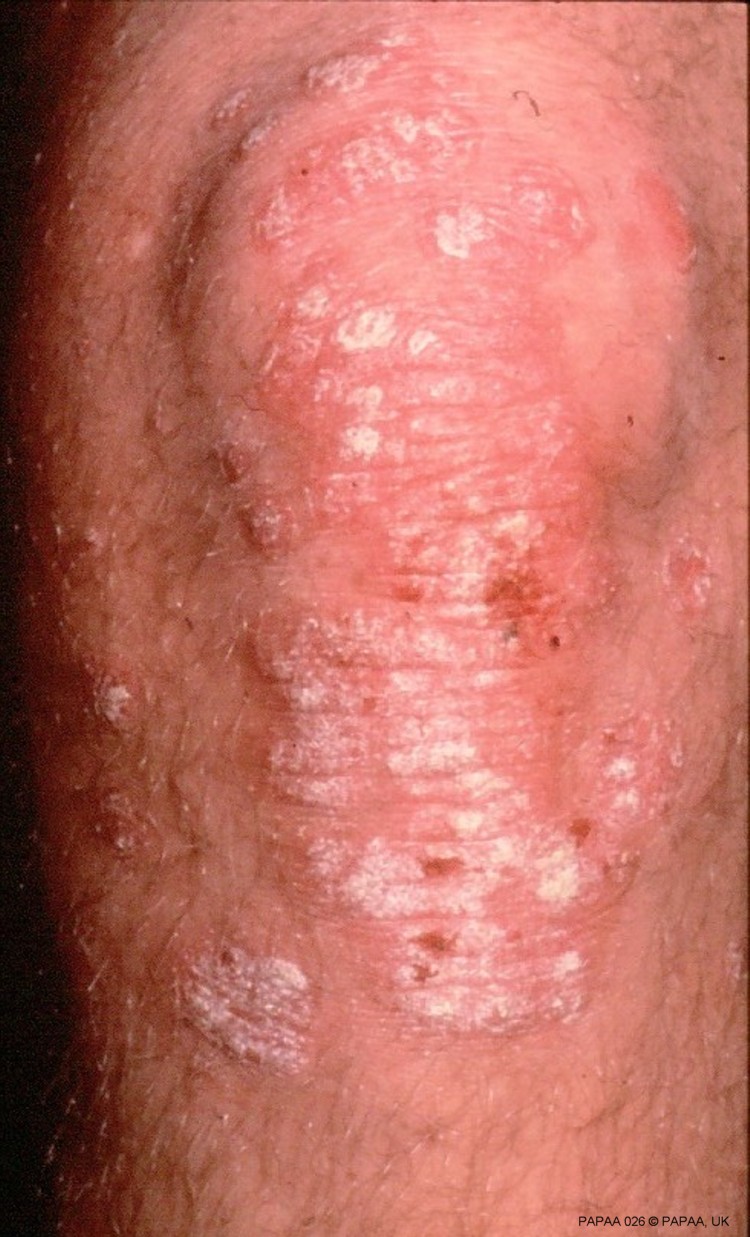 Plaque psoriasis on knee male.jpg
