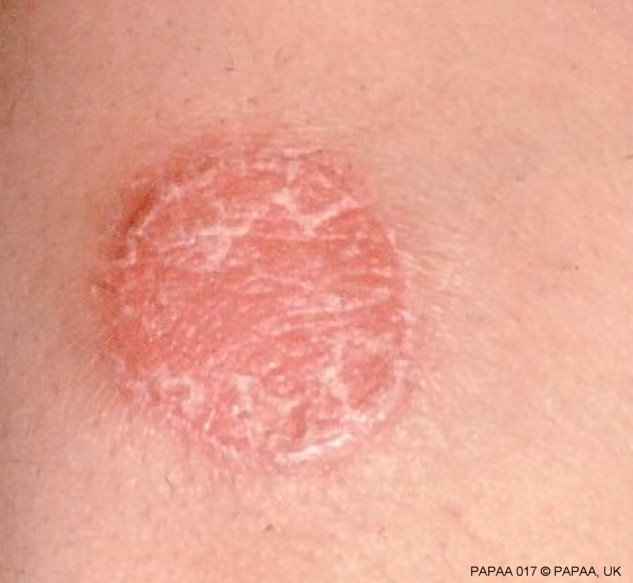 Plaque psoriasis on body.jpg