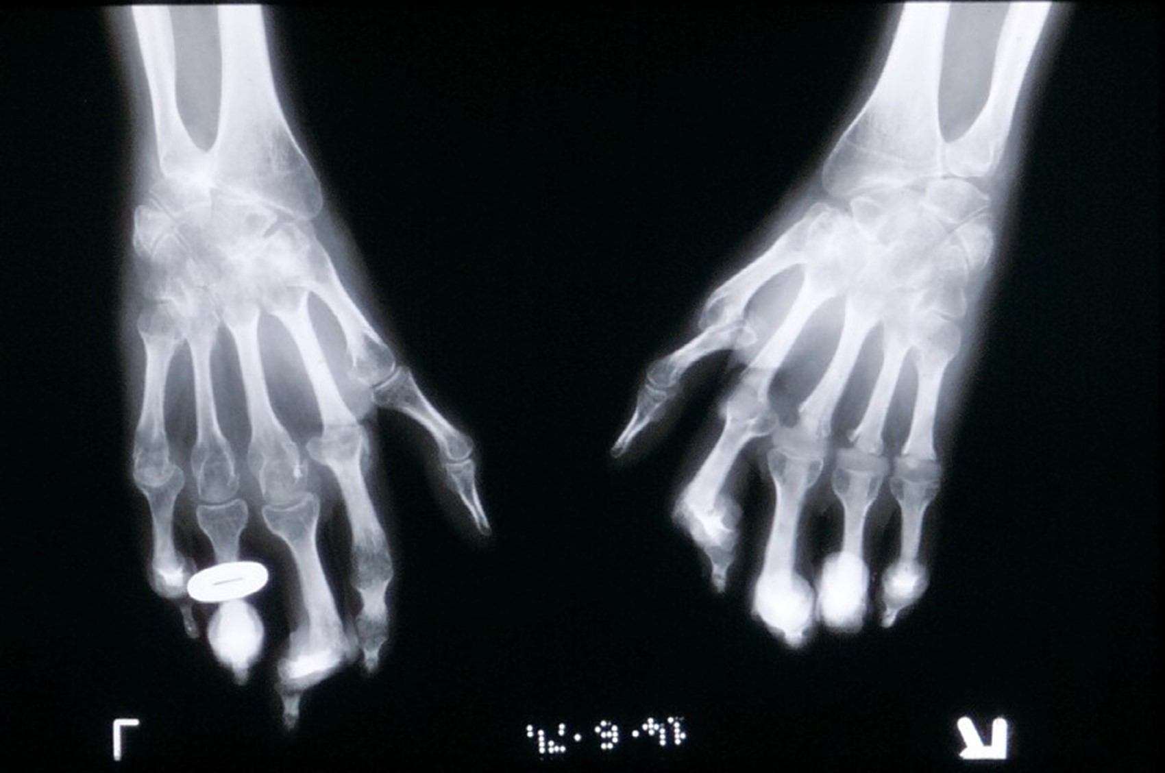 Psoriatic hands xray.jpg
