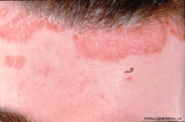 Scalp psoriasis 4.jpg
