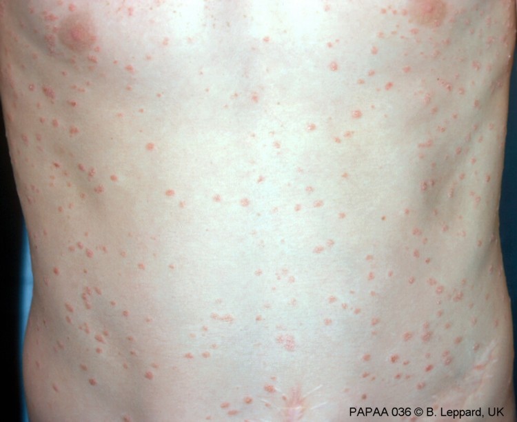Guttate psoriasis.jpg