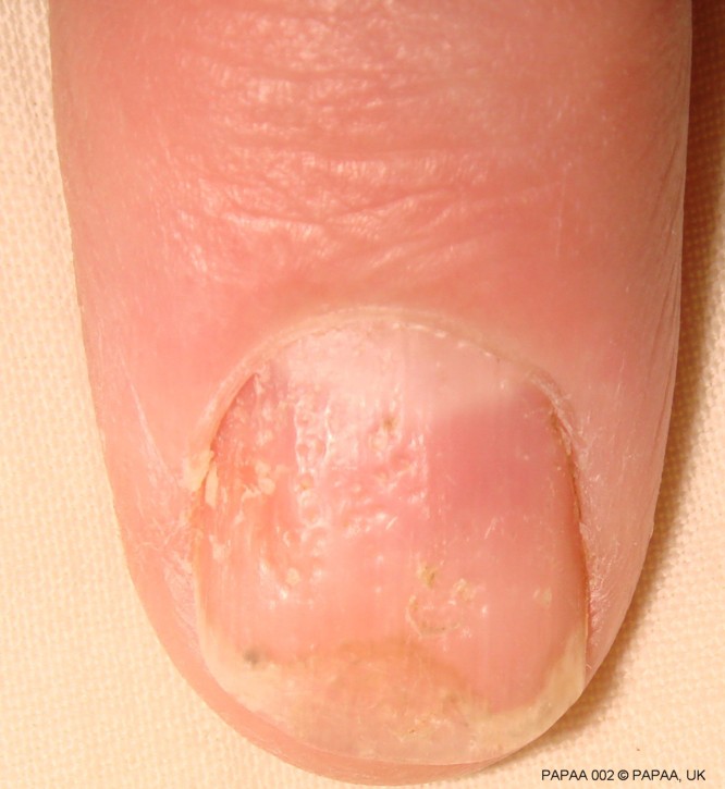 Nail psoriasis 11.jpg