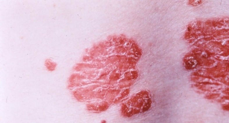 Psoriasis plaques