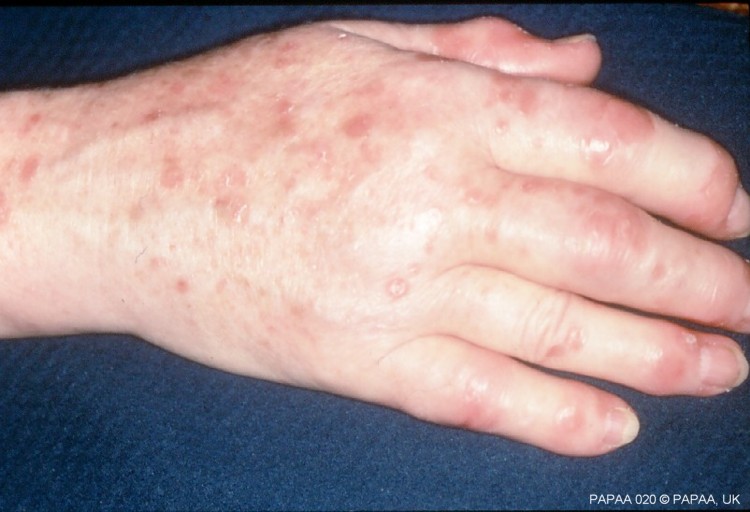 Psoriatic arthritis is an inflammatory joint condition associated with  psoriasis