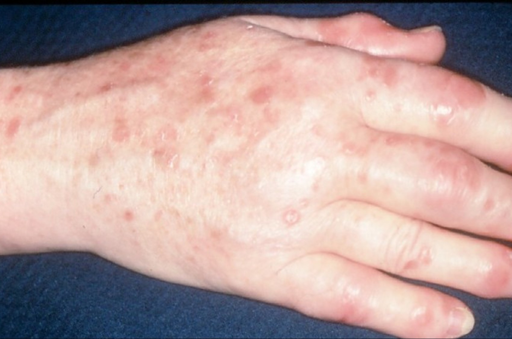 is psoriasis an inflammatory condition)