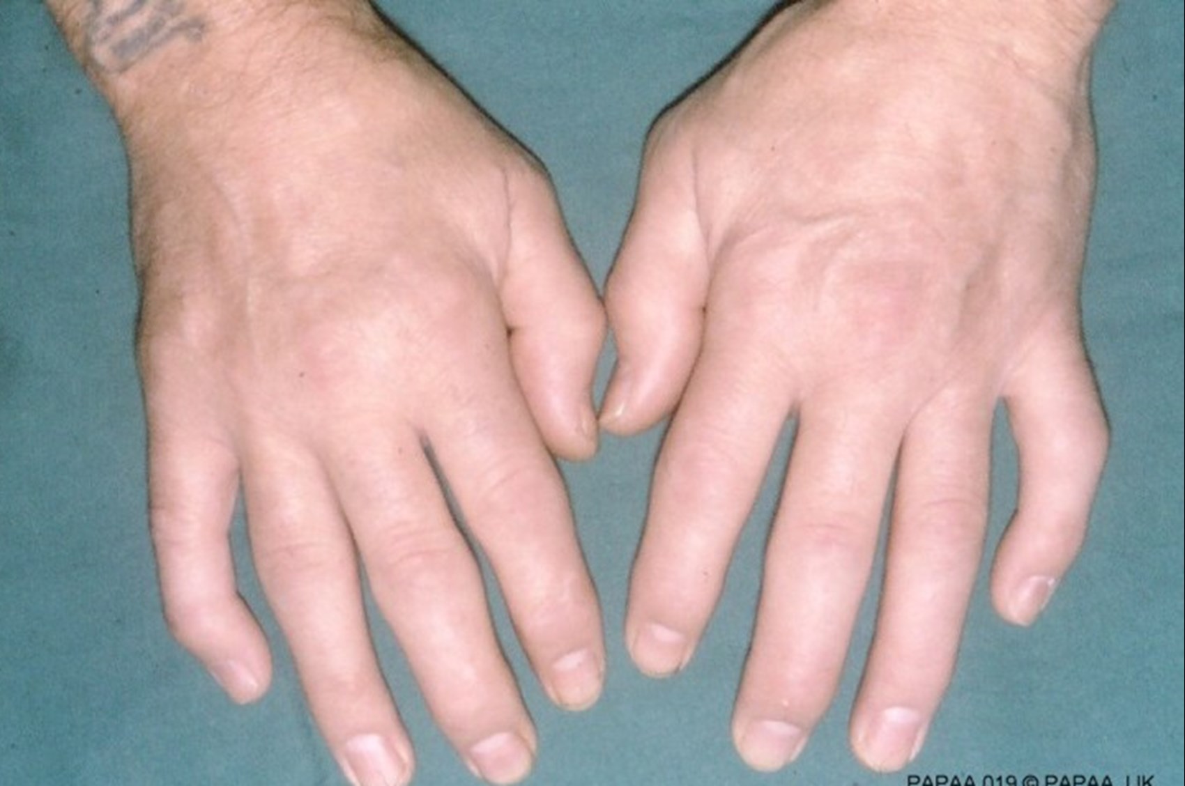 Let's Take A Look At The Strange Symptoms of Psoriatic Arthritis