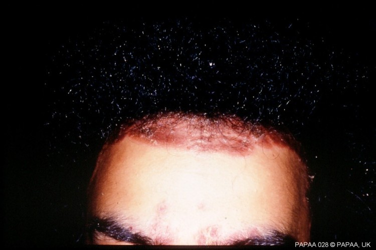 Scalp psoriasis 6.jpg