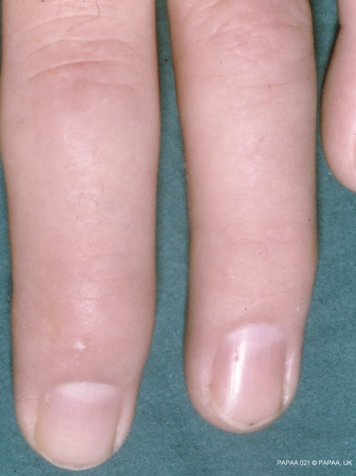 Psoriatic arthritis fingers.jpg
