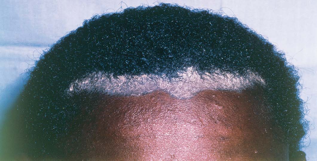 Scalp psoriasis 2.jpg